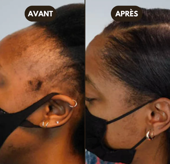 Roll Grow™ – Sérum Anti-Alopécie & Repousse Tempes Dégarnies